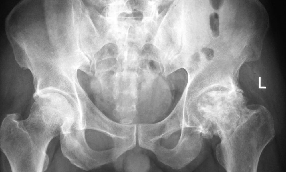 radiografie articulatie coxo femurala
