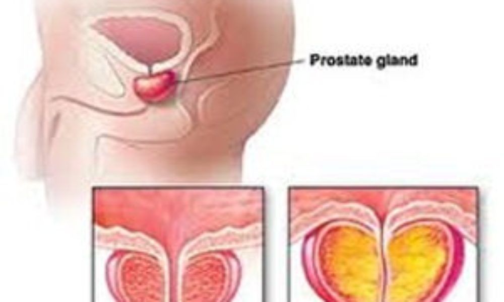 terapia prostata infiammata