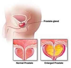 trifoi pentru prostatită sanatatea prostatei