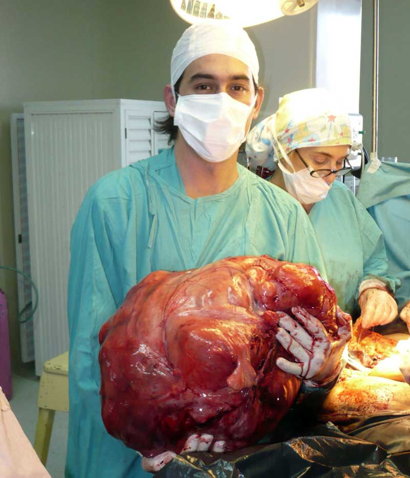 Unei argentiniene i-a fost extirpată o tumoare de 23 kg din uter