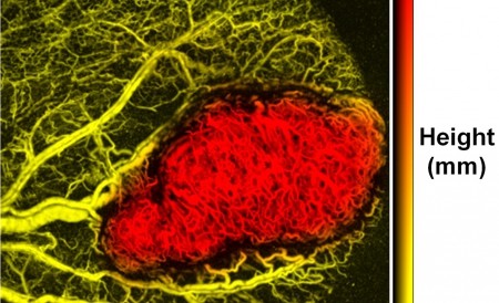Cancerul va putea fi depistat înainte de a se forma tumora