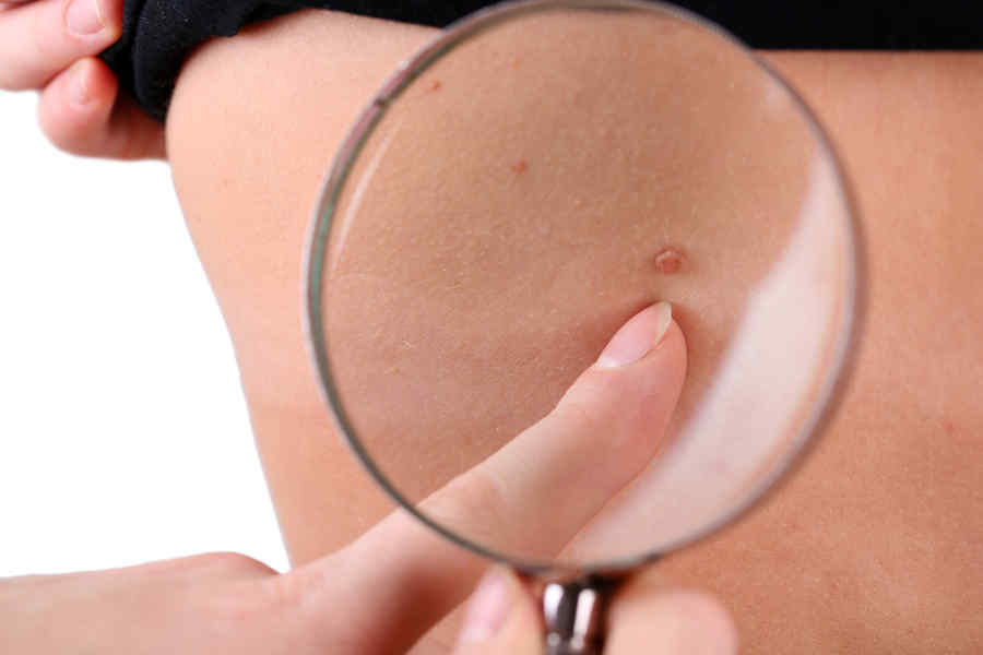 Controale gratuite anti-cancer de piele