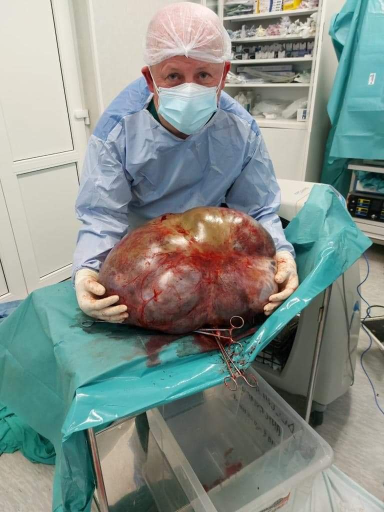 (FOTO) Tumoră-gigant descoperită la Botoșani