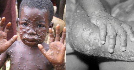 Reuniune de urgență a OMS: Variola maimuței ia amploare