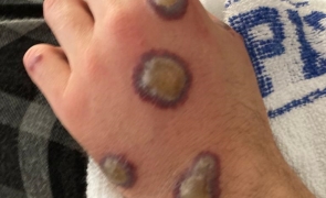 Descoperire interesantă – Românul nu avea variola maimuței, dar ce era?