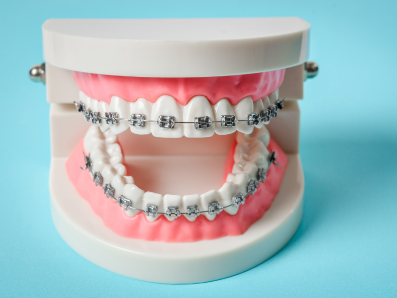 De la ce vârstă se recomandă aparatul dentar?