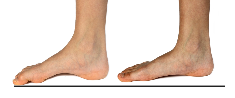 Piciorul plat: cum să previi și să tratezi această afecțiune comună