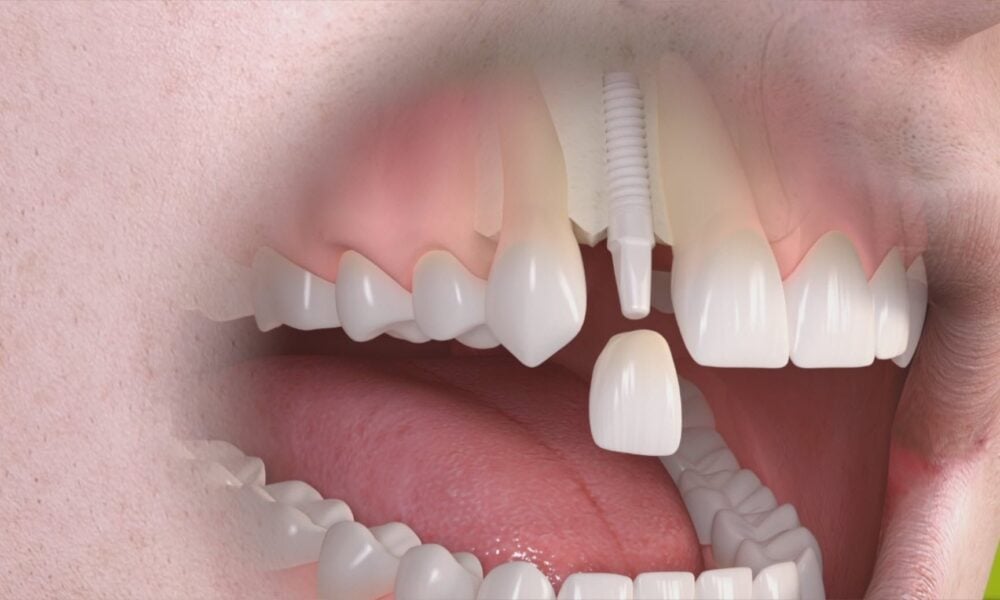 Te gândești la un implant dentar? Ce trebuie să știi înainte de a spune da
