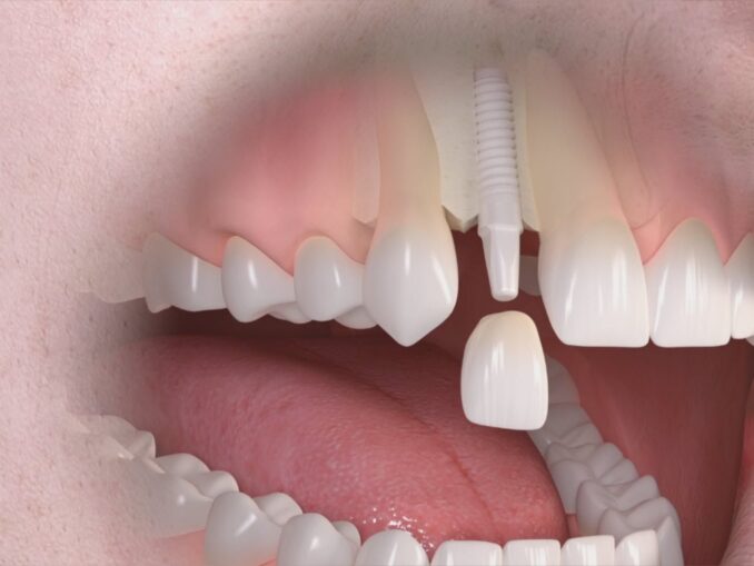 Te gândești la un implant dentar? Ce trebuie să știi înainte de a spune da