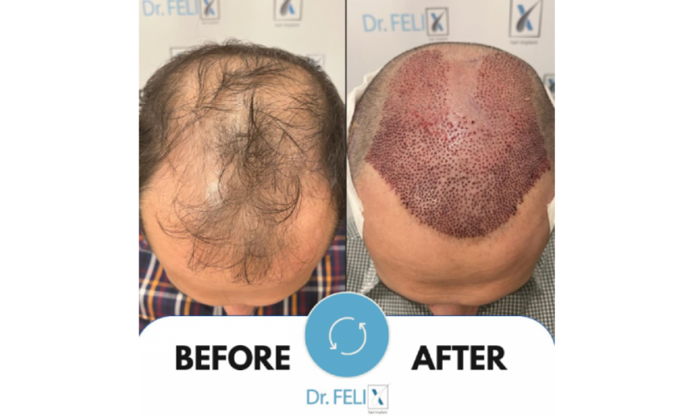 Implant de barbă – soluția  de la Dr. Felix Hair Implant pentru o barbă densă