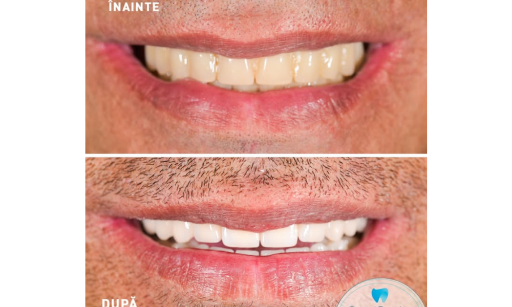 Cum afli costul unui implant dentar Straumann la clinica Dental Premier București?