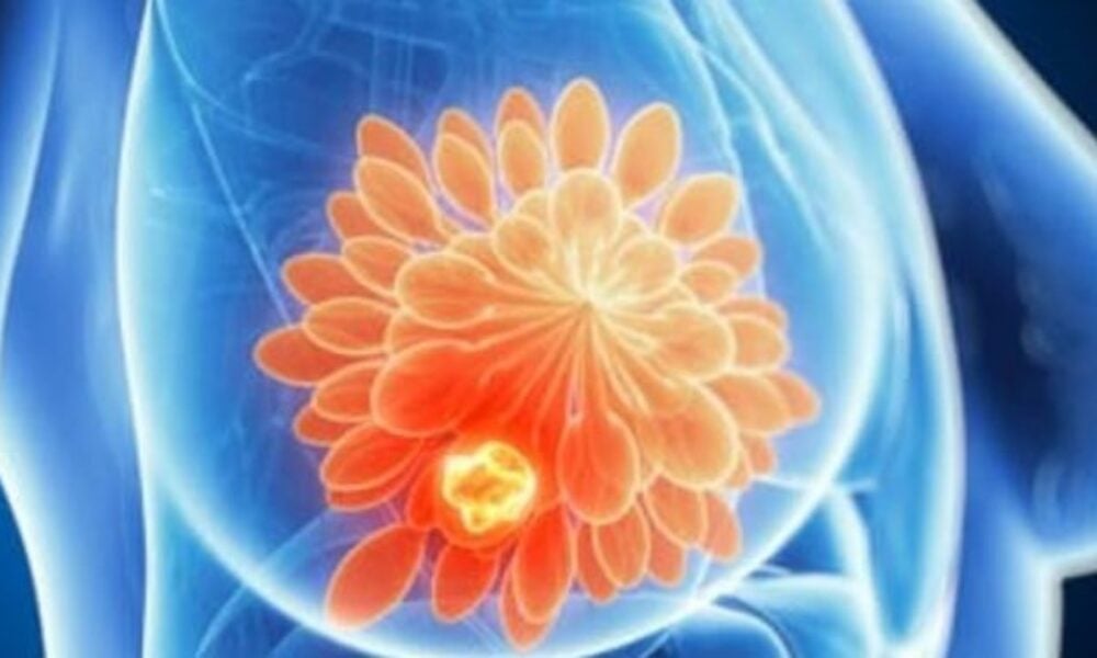 Factori cheie în recuperarea după cancerul de sân