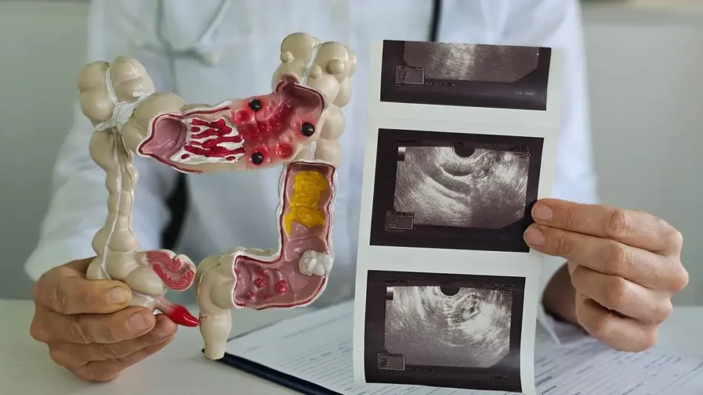 Doare sau nu colonoscopia? Ce spune Prof. Dr. Octav Ginghină despre investigația pe care trebuie să o facem pentru a preveni cancerul colorectal. Tot mai multe persoane tinere fac boala